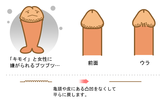 ブツブツ説明イラスト