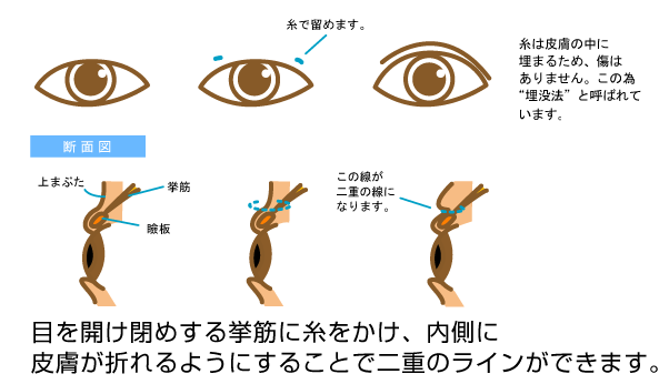 二重説明イラスト