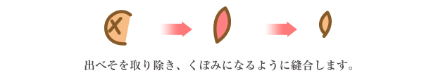 へそ形成説明イラスト