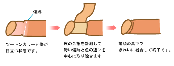他院傷跡修正説明イラスト