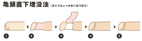 亀頭直下埋没法（きとうちょっかまいぼつほう）