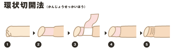 環状切開法（かんじょうせっかいほう）