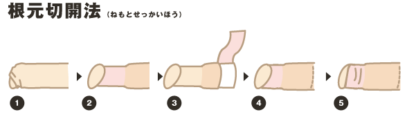 根元切開法（ねもとせっかいほう）