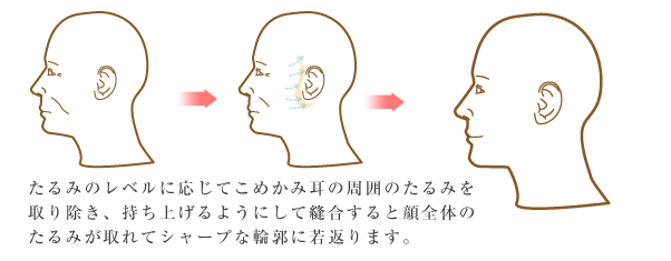 フェイスリフト説明イラスト01