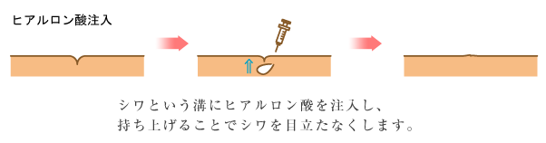 ヒアルロン酸注入説明イラスト01